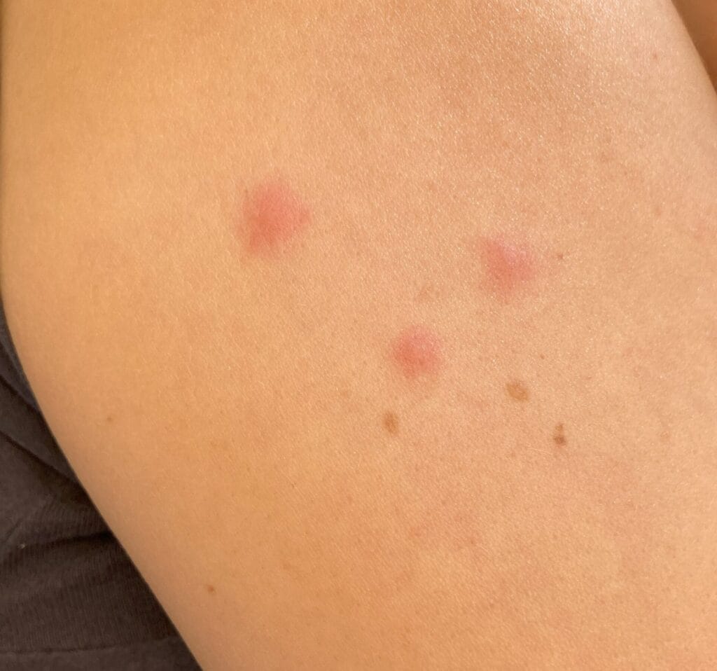 bites from bed bugs