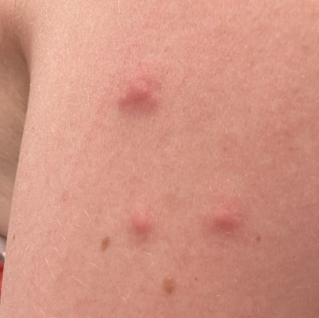 bites from bed bugs