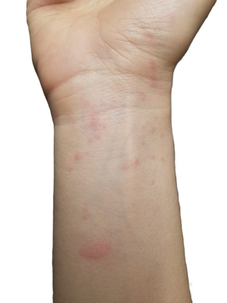 hives, urticaria on wrist and forearm