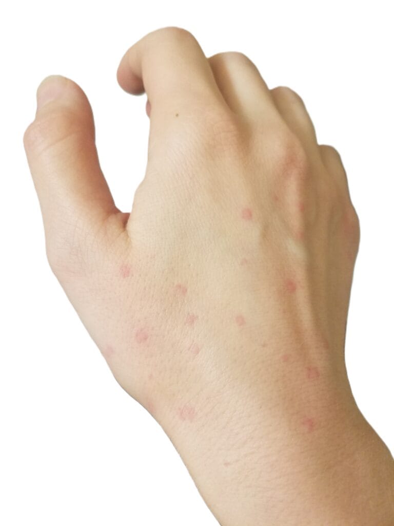 hives, urticaria on hand