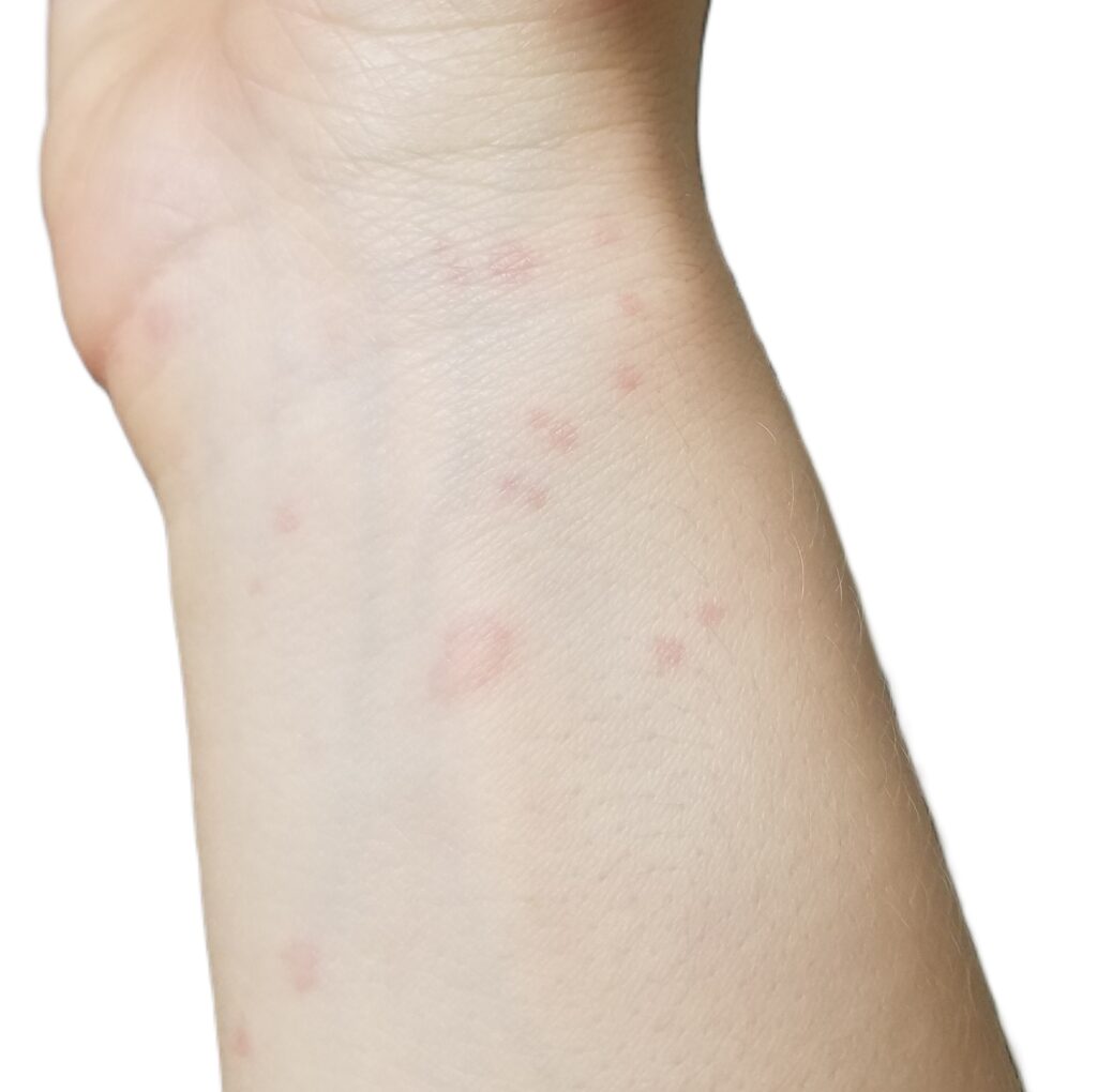 Hives, urticaria on wrist